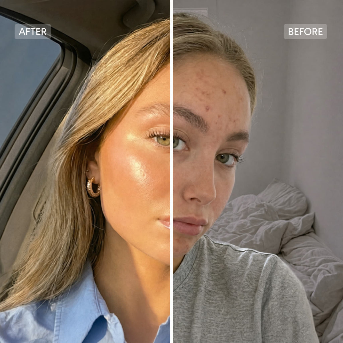 Split selfie labeled Before and After: blemished forehead on the Before side, glowing cheek on the After side