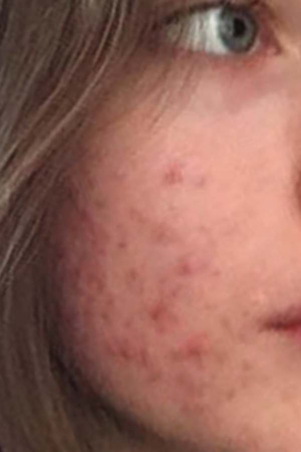 Before - Michelle T.