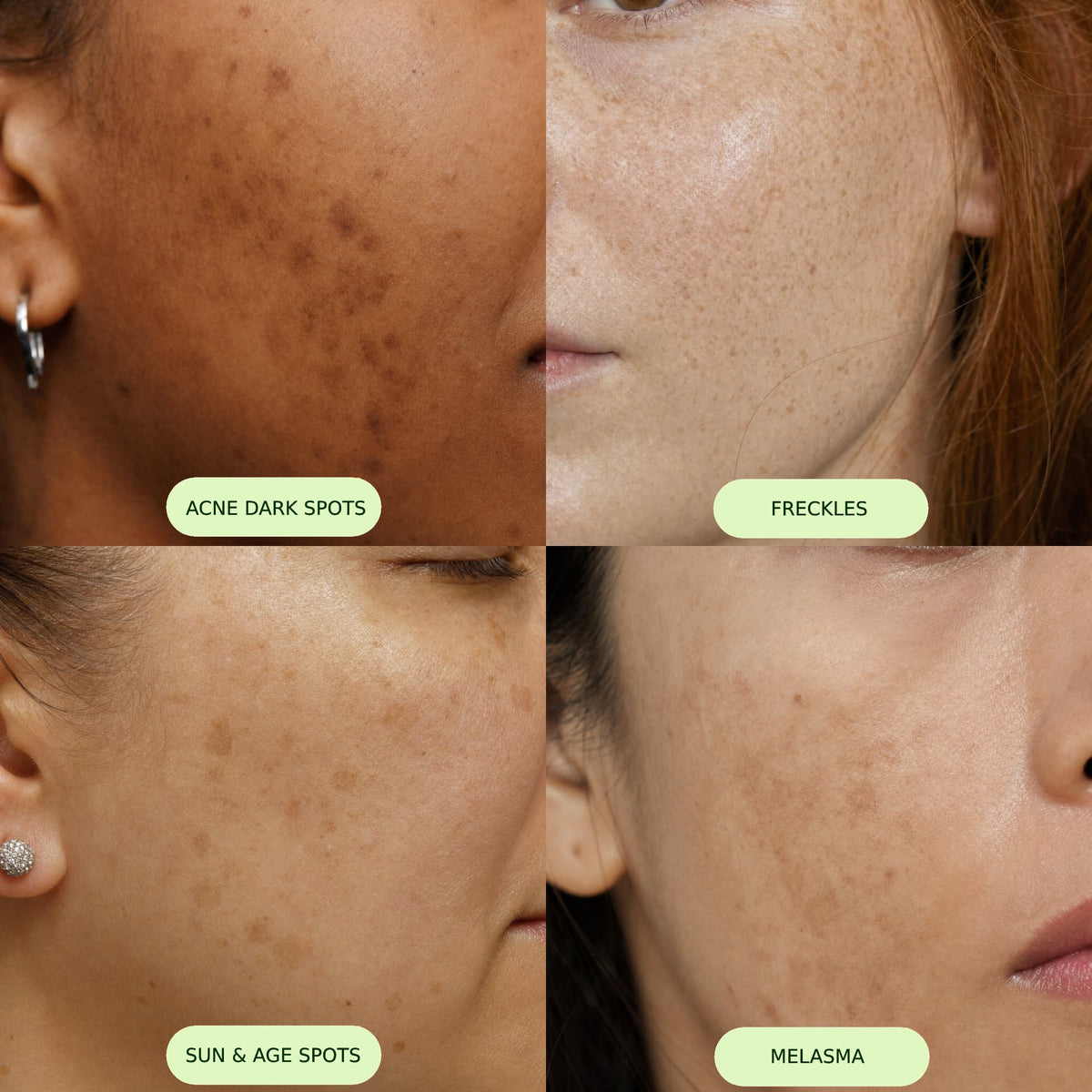 Four close-ups of cheeks showing acne dark spots, freckles, sun and age spots, and melasma, each labelled